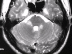 患者男，35岁，肢体无力半年。头部MRI显示如下图。根据MRI平扫和增强的表现，可能的诊断是（）