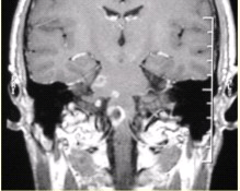 患者男，35岁，肢体无力半年。头部MRI显示如下图。根据MRI平扫和增强的表现，可能的诊断是（）