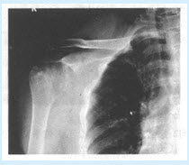 患者的右肩关节正位片如图所示，首先需要考虑哪些疾病（）