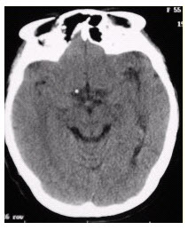 患者男，20岁，癫痫病史。头部CT显示如下图。[图]...	患者男，20岁，癫痫病史。头部CT显示如
