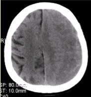 患者男，70岁。突发昏迷。头CT显示如下图。有关硬膜下血肿，描述正确的是（）