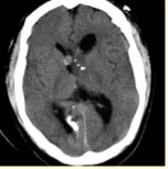 男性，24岁。反复癫痫发作。头CT及MRI显示如下图。关于室管膜下巨细胞星形细胞瘤的描述，错误的是（