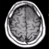 患者男，37岁。癫痫发作数次。MRI显示如下图。可能的诊断是（）