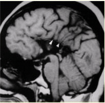 患者女，43岁。智力低下。MRI结果如下图所示。关于该病的描述，错误的是（）