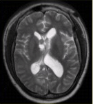 男性，24岁。反复癫痫发作。头CT及MRI显示如下图。病变的诊断为（）