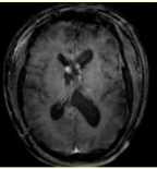 男性，24岁。反复癫痫发作。头CT及MRI显示如下图。病变的诊断为（）