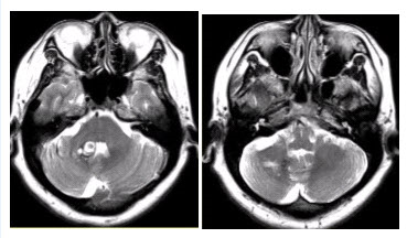 患者女，41岁。头痛半年，加重10d。头部MRI显示如下图。为进一步确定诊断，下一步的影像学检查是（