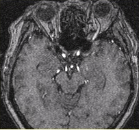 女性，62岁。外伤后左侧突眼。MRI显示如下图。关于该病，描述正确的是（）
