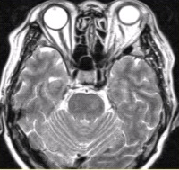 女性，62岁。外伤后左侧突眼。MRI显示如下图。关于该病，描述正确的是（）