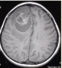 患者男，18岁，头痛15d伴复视10d，头部CT及MRI显示如下图。可能的诊断是（）