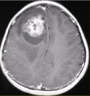 患者男，18岁，头痛15d伴复视10d，头部CT及MRI显示如下图。可能的诊断是（）