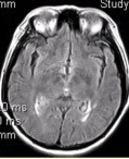 患者女，48岁。渐进性肢体无力半年。MRI所示如下图。根据脊髓和头部MRI表现，病变应诊断为（）