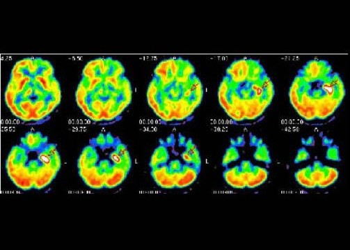 患儿6岁，反复发作抽搐2年，行F18-PET显像如图，诊断是