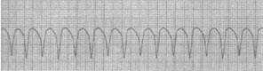 患者采用上述治疗措施后，出现了下面的心电监护波形，以下哪项描述正确（）