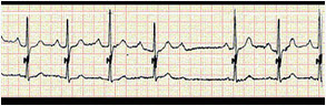 心电图如图所示：其心电图诊断为（）
