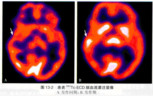 患者，32岁，反复发作抽搐2年，行发作期与发作间期99mTc-ECD脑血流灌注显像，如彩图13-2所