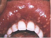复发性口腔溃疡在临床上可分为以下几型（）。