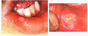 复发性口腔溃疡在临床上可分为以下几型（）。
