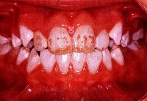 关于氟斑牙的临床表现下列哪项不正确（）。