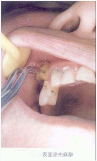 松动的乳牙拔除宜采用的麻醉方法是（）。