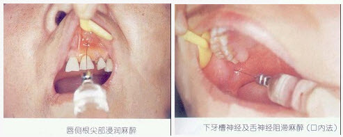 松动的乳牙拔除宜采用的麻醉方法是（）。