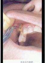 7岁患儿下颌乳中切牙松动Ⅲ度、拔除时宜采用（）。