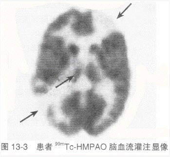 患者，男性，有高血压史10余年，99mTc-HMPAO脑血流灌注显像如图13-3所示，最可能的诊断是