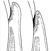 假性牙周袋与真性牙周袋的区别是（）。