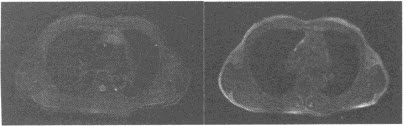 患者，男，63岁，重症肌无力1个月，胸部MRI平扫图像如下：放疗后的MR检查T1WI可见残余肿瘤为哪