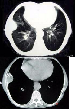 CT图像如下，最可能的诊断为()