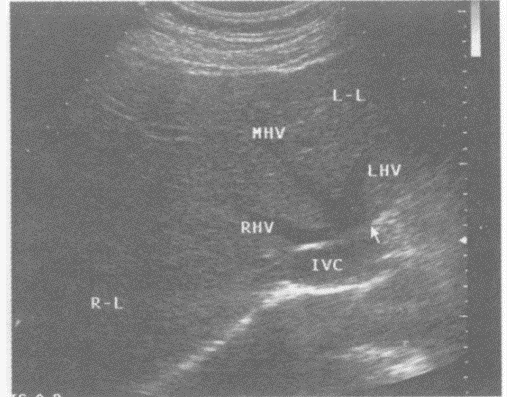 下图是肝脏横切正常超声图像，请回答箭头所指部位的解剖名称（）。