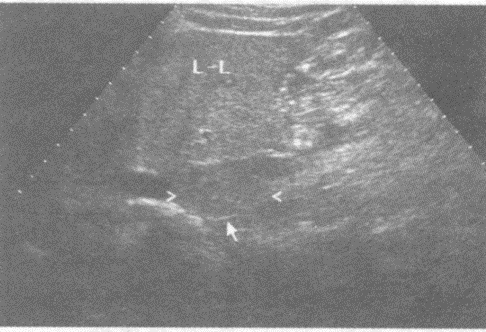 下图是肝脏纵切超声图像，请回答箭头所指部位的解剖名称（）。
