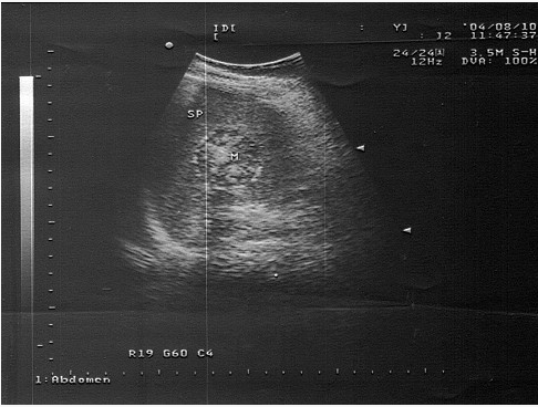 女，36岁，有乳腺癌手术史。结合超声声像图，诊断为（）。