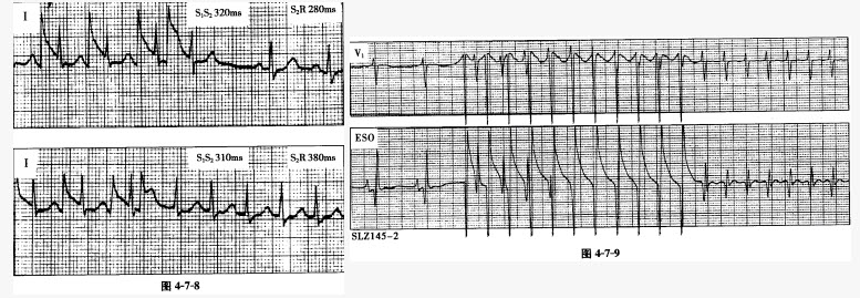 S2R间期突然跳跃延长是因为心房激动（）。