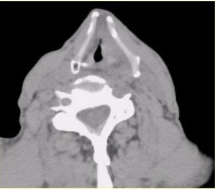 患者男，60岁，声音嘶哑半年，CT表现如下图。有关喉癌，正确的表述是（）
