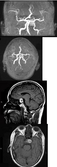 男性，55岁，头痛一年余，两个小时前突然出现剧烈头痛，MRI检查如图所示，最可能的诊断为()