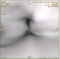 患者男，60岁，声音嘶哑半年，CT表现如下图。有关咽腔划分，正确的表述是（）