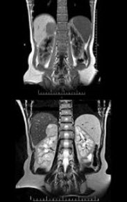 男，31岁，体检时超声发现右肾上腺区病灶，MRI扫描如图所示，下列说法正确的是()