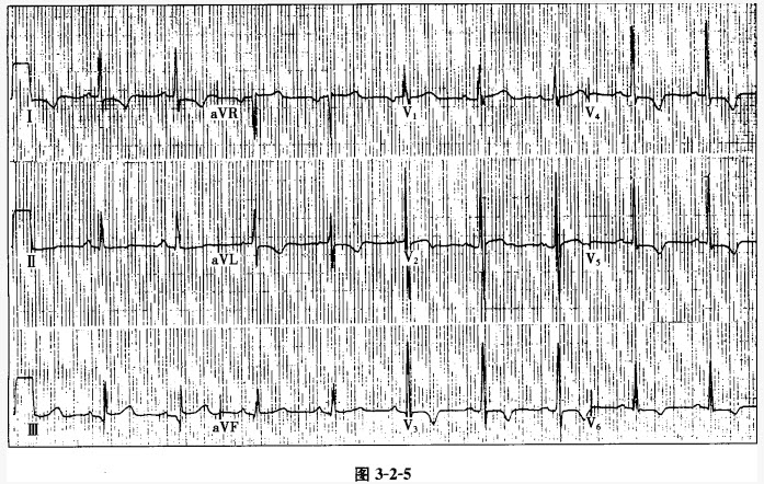结合病史，该患者的心电图改变提示（）。