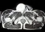 男，29岁，右侧睾丸肿痛5月余，行MRI检查，如图所示，T1加权像见右侧阴囊内见球形肿块，呈中等信号