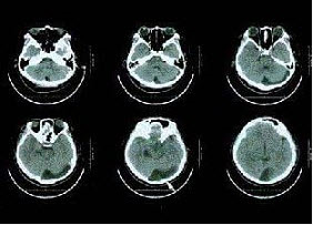 一患者反复发作头痛半年，行99Tcm-DTPA脑池显像3、6、24h图像如图及脑CT（图），诊断是（