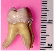 正常牙冠表面釉质最厚处厚度为（）。