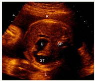 孕妇，36岁，孕1产0孕23周2d。孕16周血清学唐氏综合征筛查风险值为1/60。超声测量羊水指数为