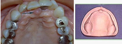 无牙颌患者的口内特征为（）。