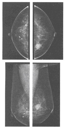 女，58岁，发现左侧乳腺肿块，质硬，与周围组织分界不清，乳腺钼靶X线图像如下，左侧乳腺的病变最可能的