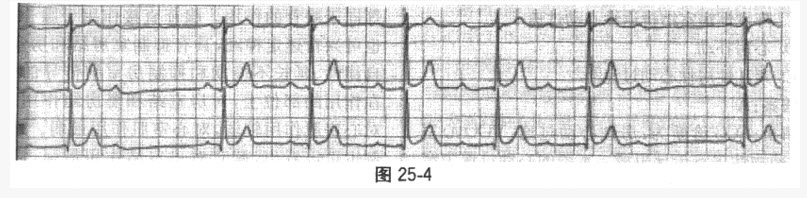一患者心电图图形如图25-4，最可能的诊断为（）。