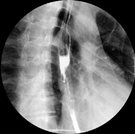 病历摘要：食管癌患者，男性，53岁，进行性吞咽困难伴胸骨后疼痛1月余。查体：心肺无异常。行食管钡餐透