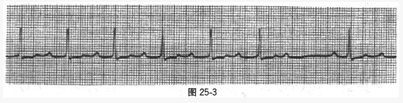 一患者心电图图形如图25-3，最可能的诊断为（）。