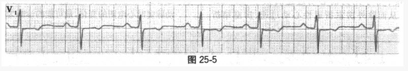 一患者心电图图形如图25-5，最可能的诊断为（）。