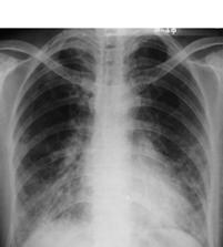病历摘要：支气管肺炎患者，男性，55岁。咳嗽、发热1周入院。查体：体温，38.1℃；双肺呼吸音粗，双